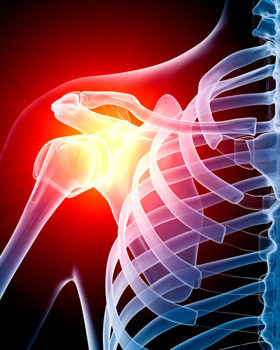 Как появляется артроз плечевого сустава? Симптомы и методы лечение.